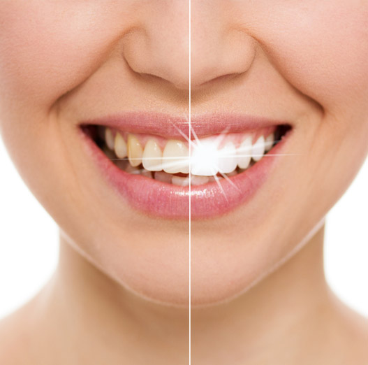Misvak Diş Fırçası ile Diş Beyazlatma: Etkili Bir Yöntem mi?