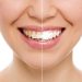 Misvak Diş Fırçası ile Diş Beyazlatma: Etkili Bir Yöntem mi?